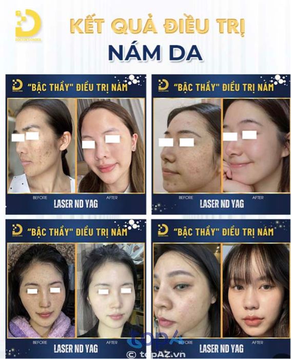 Kết quả điều trị nám da tại Doctor Choice