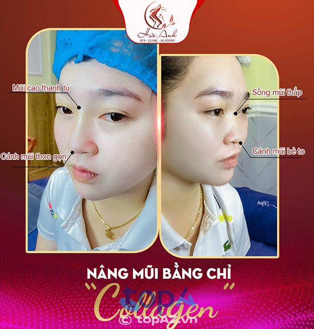 nâng mũi chất lượng tại Đồng Tháp