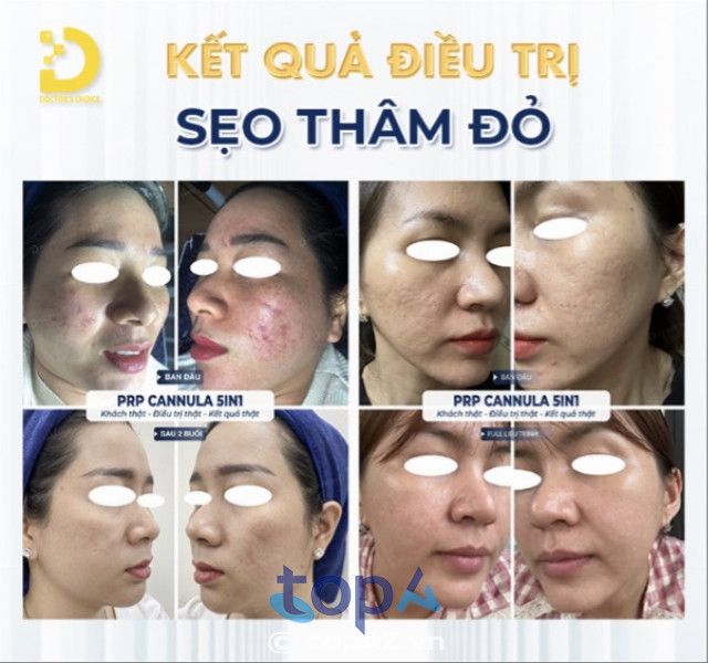 Điều trị nám uy tín tại TP. HCM - Doctor Choice Clinic