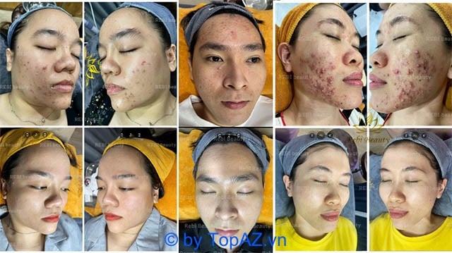 Trước và sau khi điều trị mụn tại TPHCM, lựa chọn spa uy tín nhất.