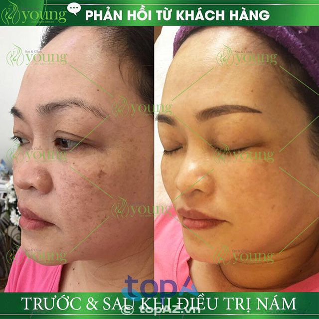 điều trị nám và tàn nhang tại TPHCM