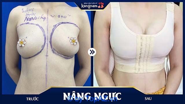 sửa ngực hỏng tphcm