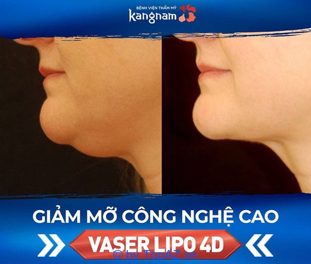 Xóa nọng cằm tại TP.HCM