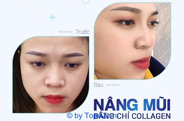 nâng mũi ở Biên Hòa