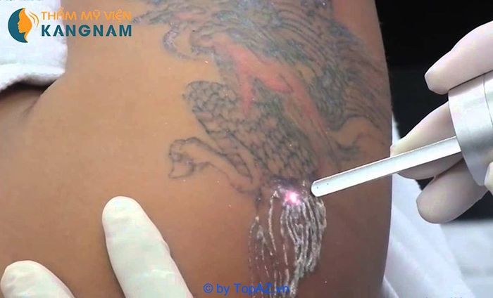 Xóa hình xăm ở đâu tại TPHCM?