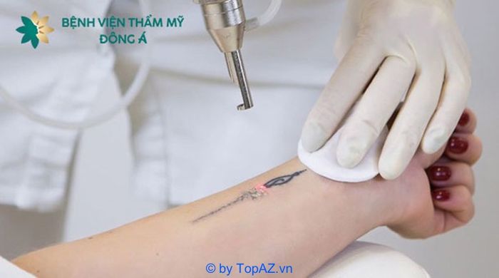 xóa hình xăm ở đâu tại TPHCM