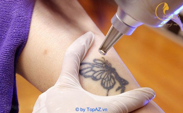 xóa hình xăm tại tphcm