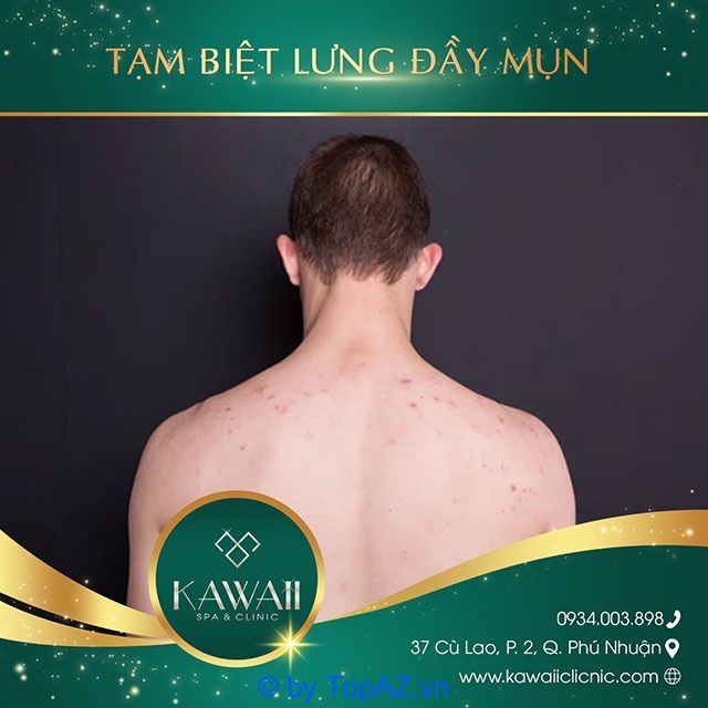 spa điều trị mụn lưng tại TPHCM