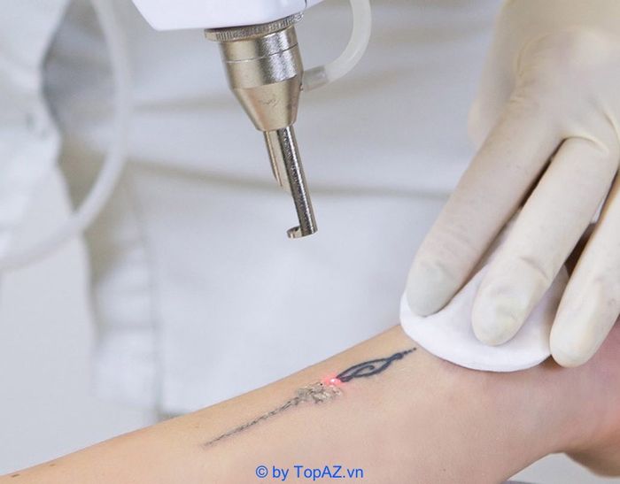 Xóa hình xăm tại TPHCM