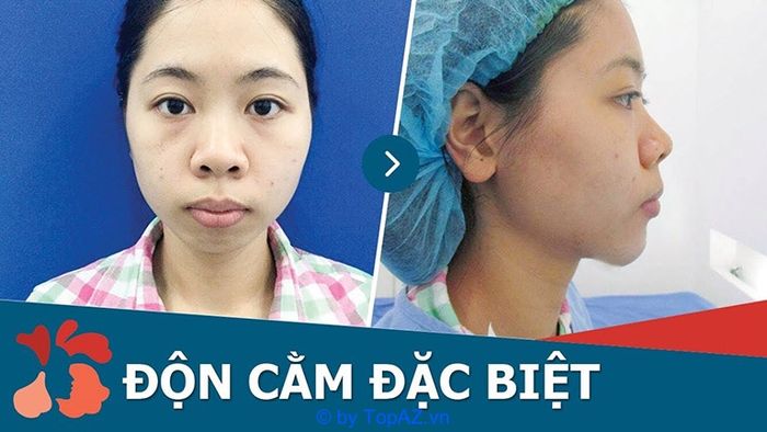 địa chỉ độn cằm uy tín tại tphcm