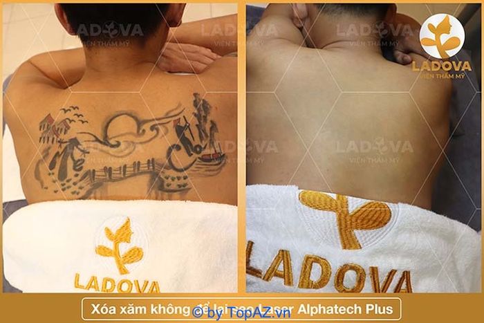 Xóa hình xăm tại TP.HCM với thẩm mỹ viện Ladova