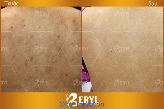 spa trị mụn lưng tại TP.HCM