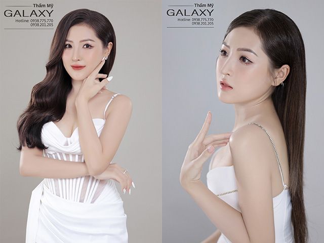 Dịch vụ độn cằm uy tín tại TPHCM tại thẩm mỹ Galaxy