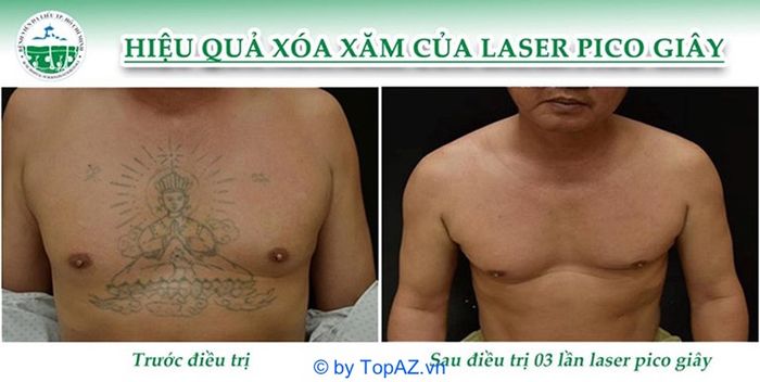 xóa hình xăm tại TP.HCM