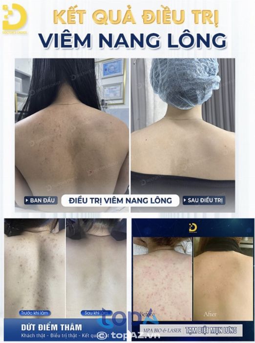 Trị mụn lưng chất lượng tại TP.HCM – Dr.Choice Clinic