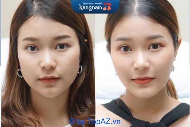 địa chỉ tiêm botox chất lượng tại TPHCM