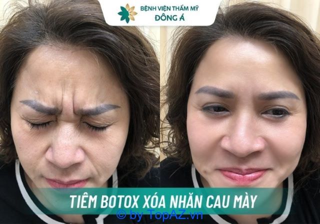 địa chỉ tiêm botox tại TPHCM