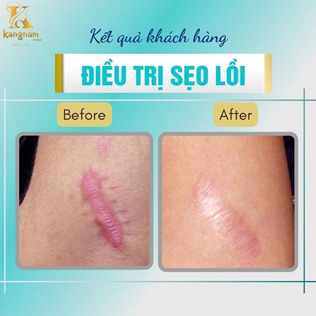 địa chỉ trị sẹo thâm tại Gia Lai