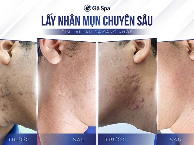 spa điều trị mụn tại Cần Thơ