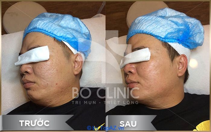 Spa trị mụn cho nam tại TP.HCM