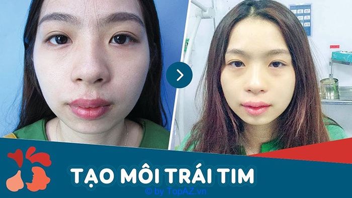 cắt môi trái tim đẹp ở đâu TPHCM