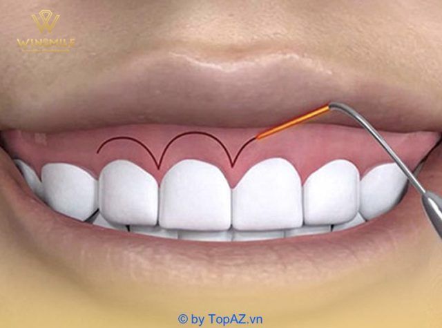 phẫu thuật cười hở lợi ở đâu tốt hà nội