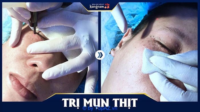 địa chỉ uy tín để đốt mụn thịt tại Hà Nội