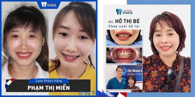 phẫu thuật cười hở lợi tốt nhất tại Hà Nội