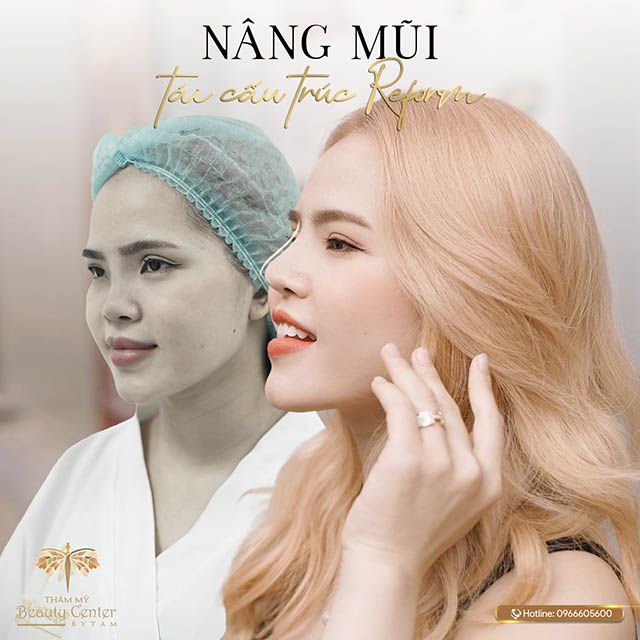 Nâng mũi chất lượng tại Hà Nội tại Thẩm mỹ viện Tấm