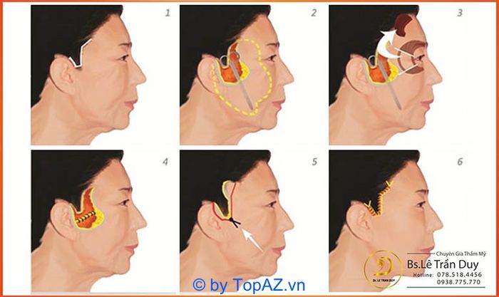 Phẫu thuật độn thái dương tại TP.HCM