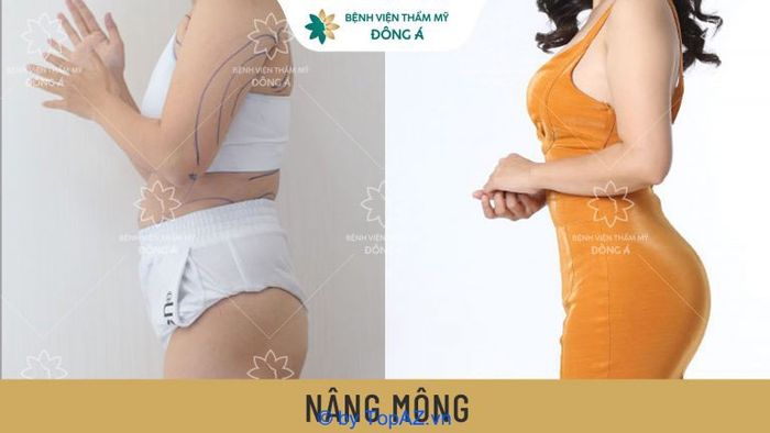 Nâng mông nội soi ở đâu tốt tại TP.HCM?