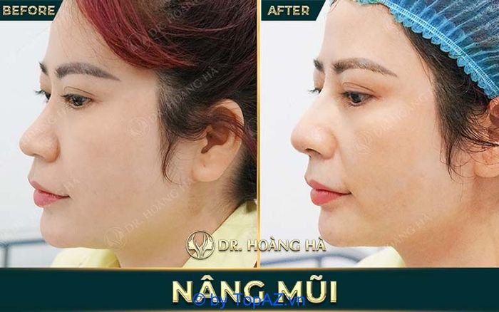 nâng mũi tại Hà Nội