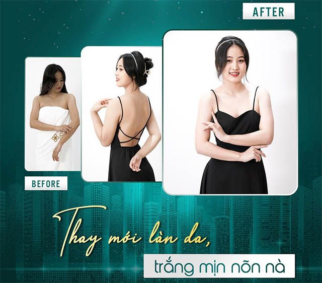 Dịch vụ tiêm truyền trắng da tại Spa Anchee Clinic ở TPHCM