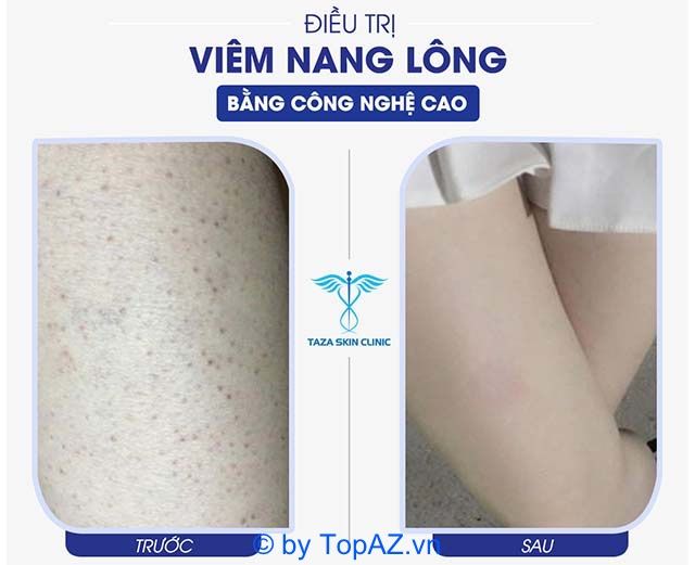 điều trị viêm nang lông ở đâu tphcm