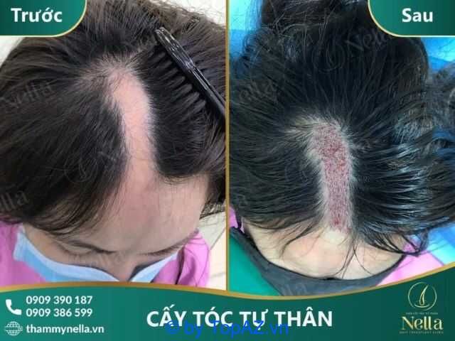 địa chỉ cấy tóc tại TPHCM