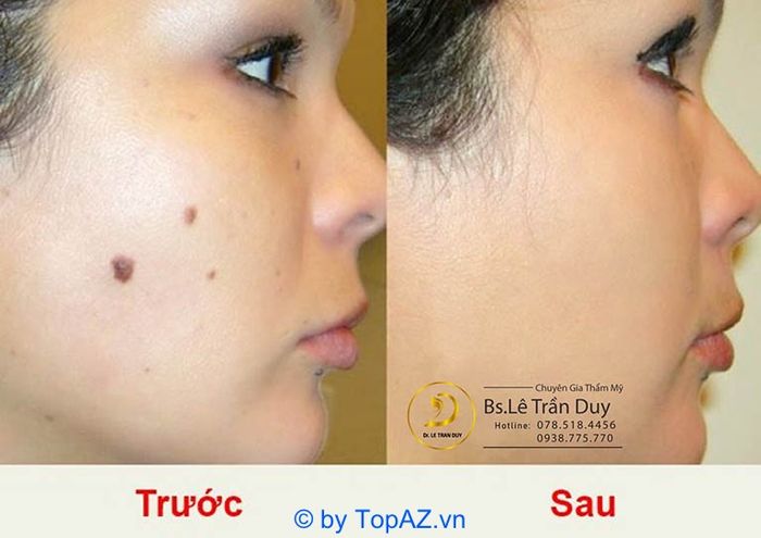 dịch vụ tẩy nốt ruồi tại TPHCM