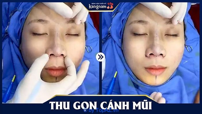 thu gọn cánh mũi ở đâu đẹp và an toàn hà nội