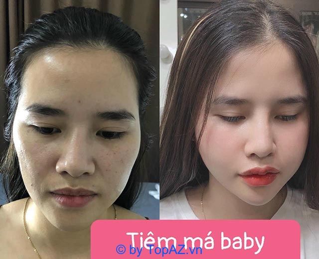 Tiêm filler tại Quy Nhơn