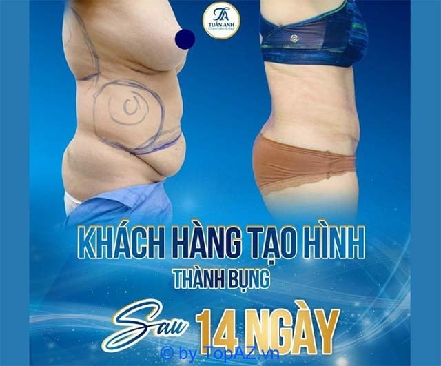 tạo hình bụng tại Hà Nội