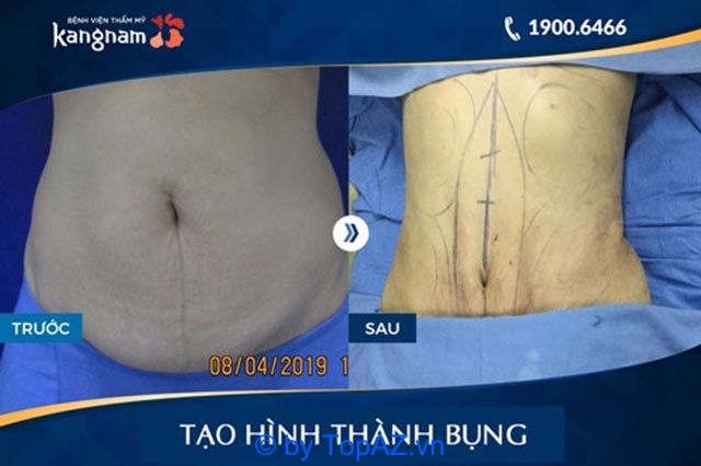 tạo hình bụng tại Hà Nội