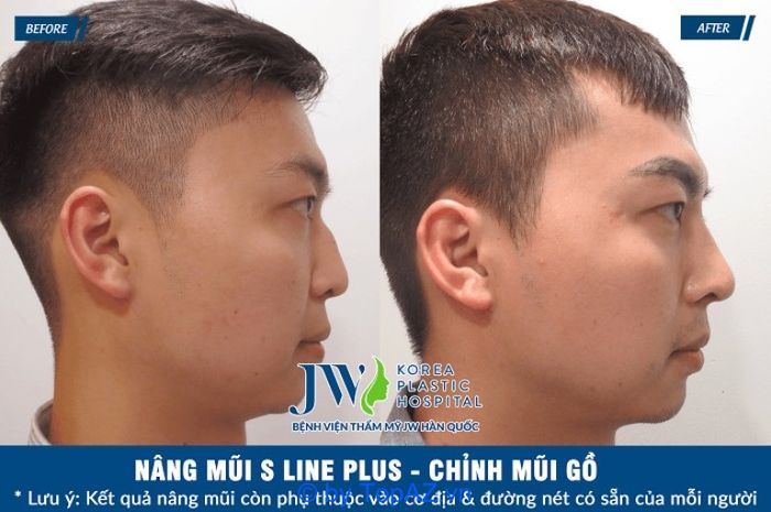 Địa chỉ nâng mũi dành cho nam giới đẹp tại TPHCM