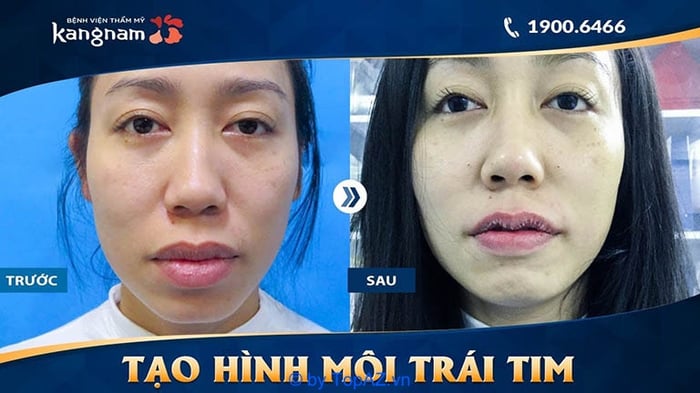 Địa chỉ cắt môi trái tim đẹp tại Hà Nội