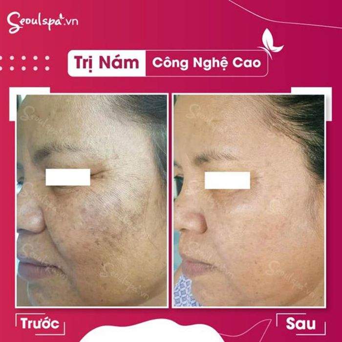 Dịch vụ trị nám tại SeoulSpa có đạt hiệu quả rõ rệt trước và sau điều trị không?