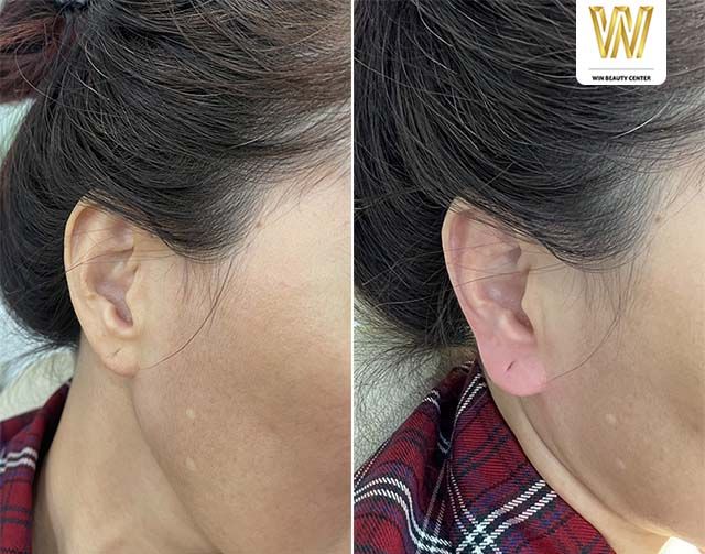 Thẩm Mỹ Quốc Tế Win tiêm filler