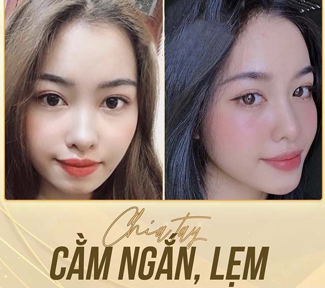 Thẩm Mỹ Quốc Tế Win tiêm filler