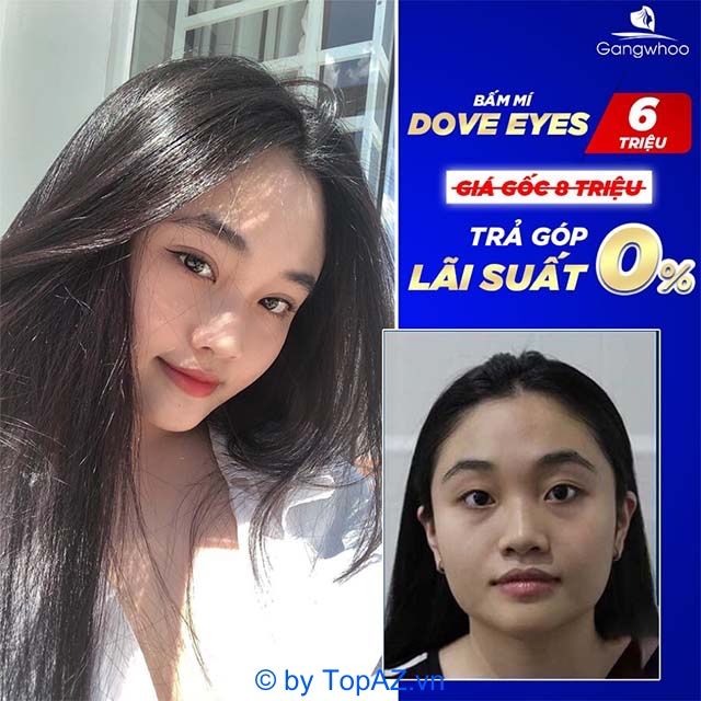 Bấm mí Dove Eyes tại Thẩm mỹ viện Gangwhoo