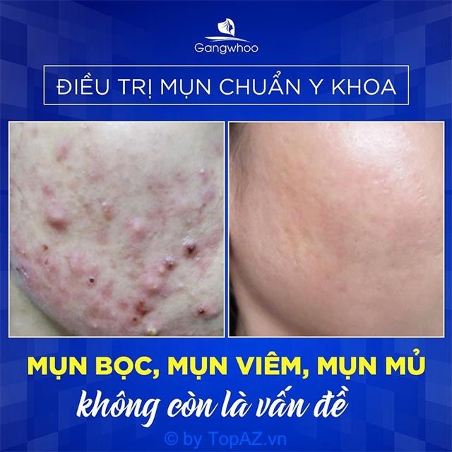 Trị mụn bọc, viêm mủ tại Thẩm mỹ viện Gangwhoo