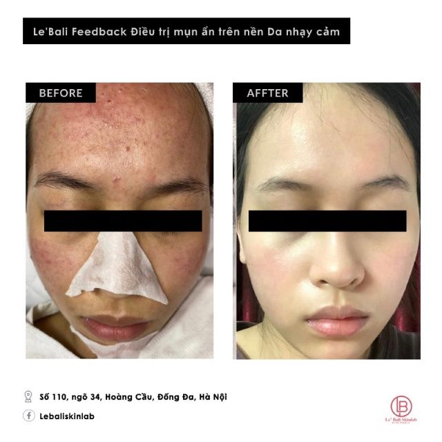 Kết quả điều trị mụn tại Le’ Bali SkinLab Hà Nội