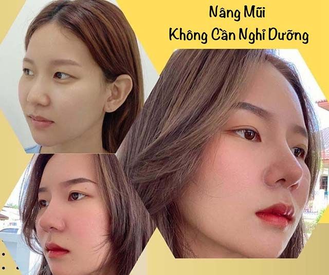 Thẩm mỹ Quốc tế Win - Dịch vụ tiêm filler