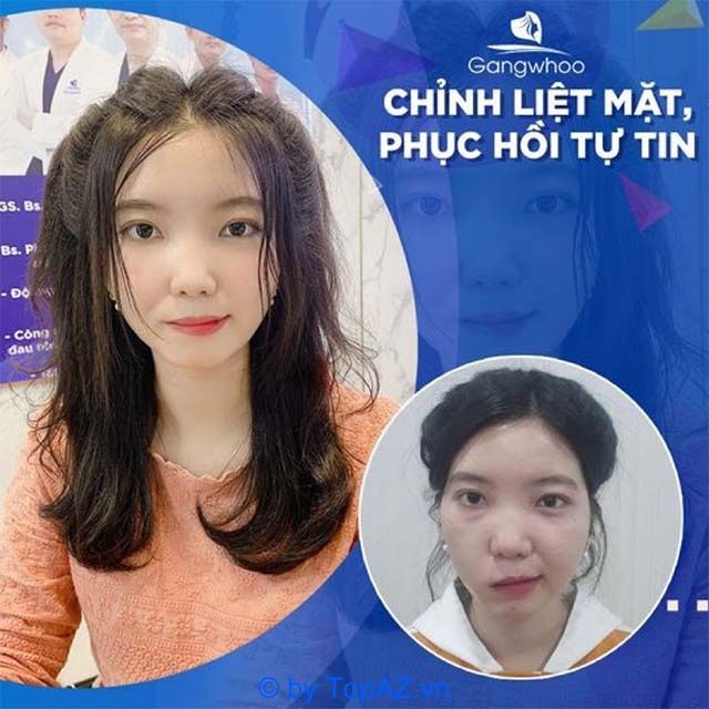 Chỉnh liệt mặt tại Thẩm mỹ viện Gangwhoo